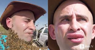 נעקצתם פעם אחת על ידי דבורה ושמחתם לגלות שאתם לא אלרגים? אל תמהרו כל כך  לשמוח. אלרגיה לעקיצת דבורה יכולה להתגלות רק בפעם השנייה שתיעקצו, או אפילו  אחרי! למעשה, אלרגיה לכל עקיצה