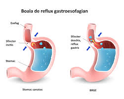 Arsurile la stomac se produc atunci cand acidul din stomac se intoarce in tubul musculomembranos (esofag) care transporta. Boala De Reflux Gastroesofagian Cauze Simptome Remedii Secom Ro