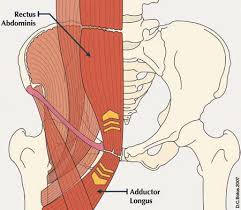 Athletic Pubalgia and “Sports Hernia”: Optimal MR Imaging Technique and Findings