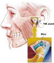 Tmd Treatment With Dr Kaspo Troy Mi