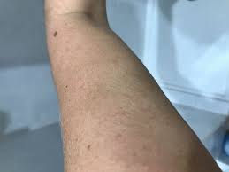 Existe La Alergia Al Sol Como Saber Si La Padezco