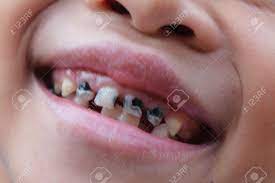 Criança Pequena Com Dentes Quebrados E Podres Foto Royalty Free, Gravuras,  Imagens e Banco de fotografias. Image 15878409