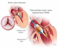 Medical Illustration Of Aortic Valve Stenosis And Transcatheter Aortic Valve Replacement Tavr Aortic Valve Replacement Stenosis Aortic Stenosis