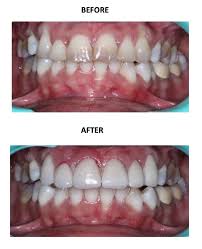 Looking for the cost of porcelain veneers in new york city? Cost Of Dental Veneers In India The Dental Specialists