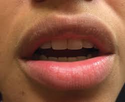 We did not find results for: Small White Spots On The Lips Mdedge Dermatology