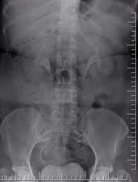 Image result for Intravenous Pyelogram
