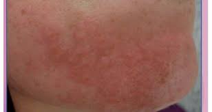 Image result for dermatitis contacta toxica