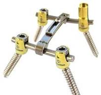 CapLOX II Pedicle Screw System - Pedicle Screws and Rods