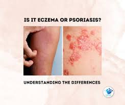 Image result for psoriasis
