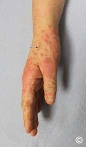 Image result for scabies bite
