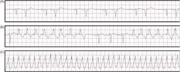 Idiopathic Ventricular Tachycardia An Overview Sciencedirect Topics