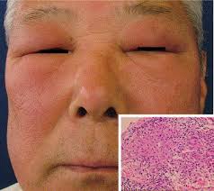 Chronic sarcoidosis is not necessarily preceded by acute. Sarcoidosis Manifesting As A Periorbital Purplish Rash The American Journal Of Medicine