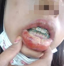 Sila bawa dokumen tersebut semasa hadir ke pejabat: Gara Gara Fake Braces Bibir Jadi Bernanah Dan Demam Panas Berlanjutan Selama 3 Hari Sungguh Menakutkan