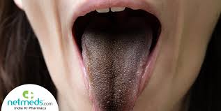 Image result for brown tongue symptoms