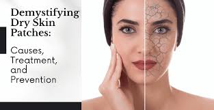 Image result for Dry Skin Management