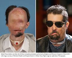 Miracle Transplant: Wearing the Face of a Dead Man