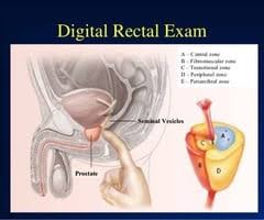 Identify the symptoms of early prostate cancer. Mkyxccjgiwrtim