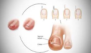 home remes to cure ingrown toenail