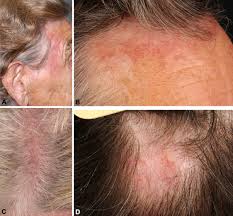 It may be sudden or slow. Atypical Clinical Presentation Of Primary And Secondary Cutaneous Follicle Center Lymphoma Fcl On The Head Characterized By Macular Lesions Journal Of The American Academy Of Dermatology