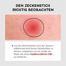 Auch die nachsorge können sie bei komplikationslosen zeckenbissen selbst übernehmen. Zecken Zeckenbisse Wie Gefahrlich Sind Zecken Wirklich