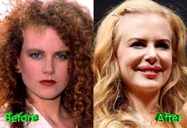 Nicole Kidman Plastic Surgery Before And After Plastic Surgery Celebrity Plastic Surgery Cosmetic Surgery