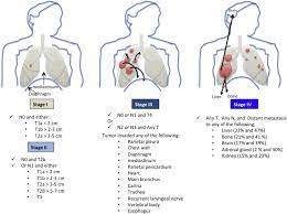 Signs and symptoms of lung cancer may include: Lung Cancer Biology And Treatment Options Sciencedirect