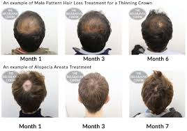 A study of young men diagnosed with male pattern baldness showed that the blood flow to. Advice On Treating Bald Spot Caused By Male Pattern Hair Loss