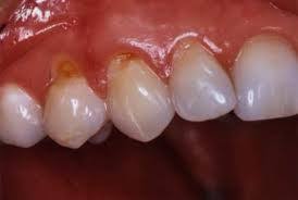 Image result for Tooth Abrasion