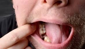 Image result for Dry Socket