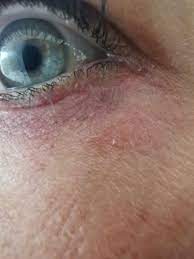 Ausschlag Unter Dem Auge Gesundheit Und Medizin Haut
