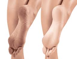 What Really Causes Cracked Heels And How To Heal Them Part 2 Gotham Footcare Podiatrists
