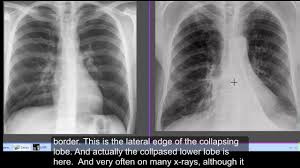 Meaning of apical lordotic projection medical term. Apicolordotic View By Adlemi Fei