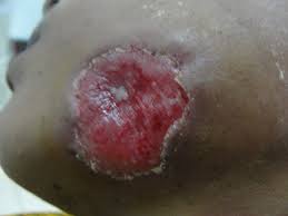 Necrotizing fasciitis may also rarely occur due to monomicrobial infection with other pathogens as listed below. Necrotizing Fasciitis Of Face Our Experience In Its Management Bmj Case Reports