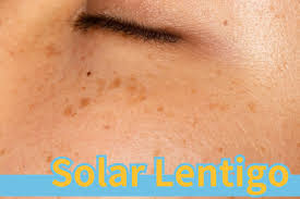 Image result for Solar Lentigo