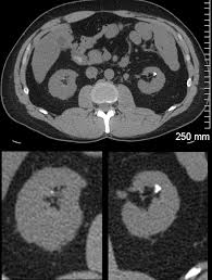 Image result for Nephrolithiasis