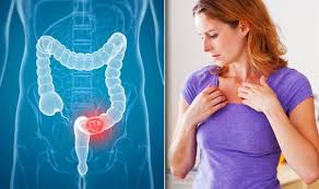 Two oncology clinical nurse specialists and their staff can provide information and answer questions about cancer. Bowel Cancer Symptoms Signs Of A Tumour Include Having Itchy Skin Express Co Uk