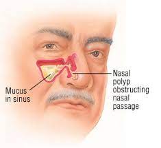 The nasal cavity refers to the interior of the nose, or the structure which opens exteriorly at the nostrils. Nasal Polyps Guide Causes Symptoms And Treatment Options