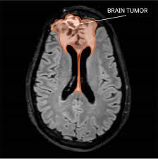 But this increased trend in glioblastomas of the frontal and temporal lobes and cerebellum is not evident when all brain cancers are considered. Oligodendroglioma Diagnosis And Treatment National Cancer Institute