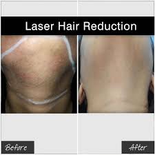 Create an account to join the conversation. Faq S Laser Hair Removal Radiant Skin Clinic Laser Hair Removal Dermatologist In Jaipur