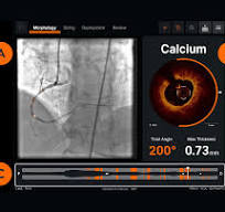 Optical Coherence Tomography (OCT) Intravascular Imaging ...