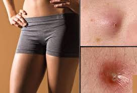 There Are A Few Among Us That Have Boils On Our Thighs And Buttocks And This Article Shows Us How To Get Rid Of Bo Inner Thigh Boils Get Rid Of