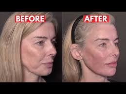 How to minimise jowls for your patients! (It's not JUST about injection  technique)