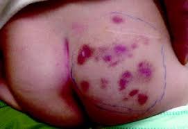 Dermatological Disorders and Artifacts