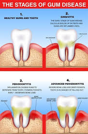 Dentaltown Different Disease Stages There Know Did You Are Gum Ofdentaltown Did You Know There Are Different Dental Health Dental Insurance Dental