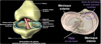 Faites le point sur votre situation actuelle. Les Lesions Meniscales Osteopathe Specialise En Phoniatrie Dans Le Centre De Lyon
