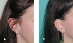 In more severe cases, a revision facelift may be advisable. Avoiding Pixie Ear Deformity In Face Lifts Dr Laguna