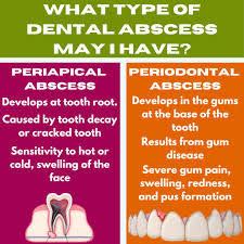 Image result for Periodontal Abscess