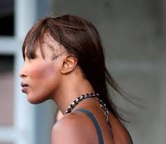 Commentary: Living with Alopecia