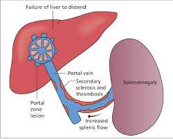 The portal vein transports the raw materials of digestion from the intestines to the liver for processing. The Hepatic Artery Portal Venous System And Portal Hypertension The Hepatic Veins And Liver In Circulatory Failure Semantic Scholar