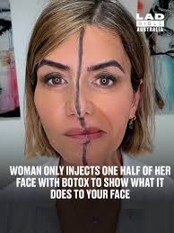 She injected half of her face so you don't have to 🤯💉